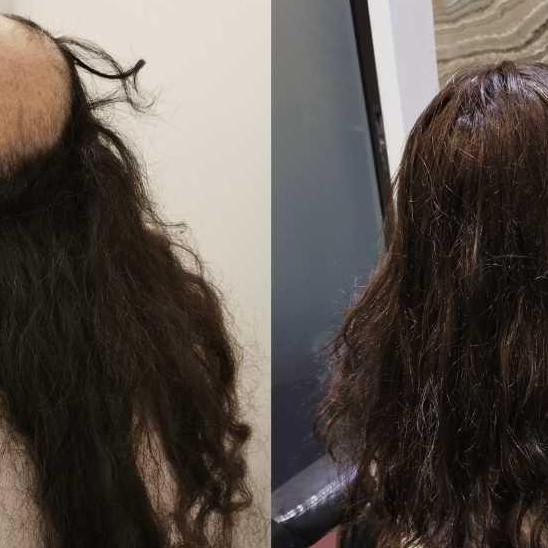 Hair Replacement  Singapore
