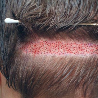 Hair Transplant  In Pakistan